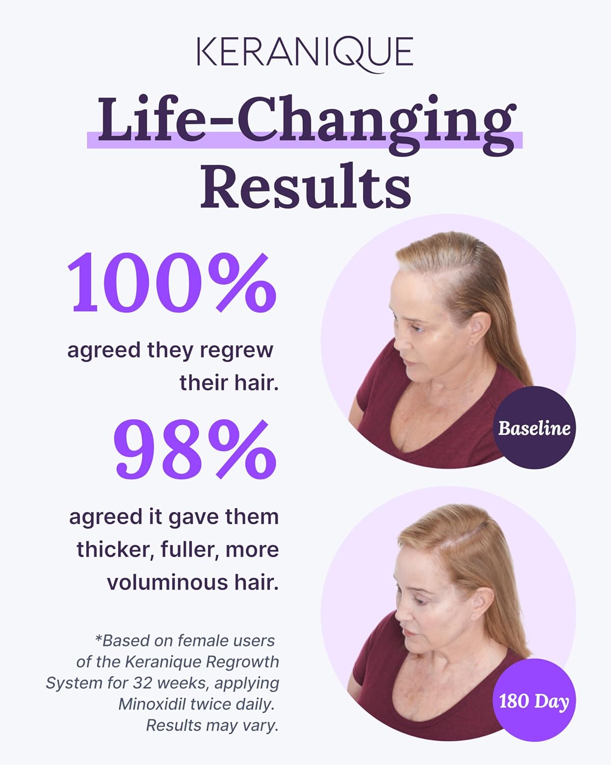 Hair Regrowth Tonic with 2% Minoxidil for Thinning Hair J928141